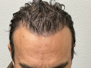 Hair Transplant