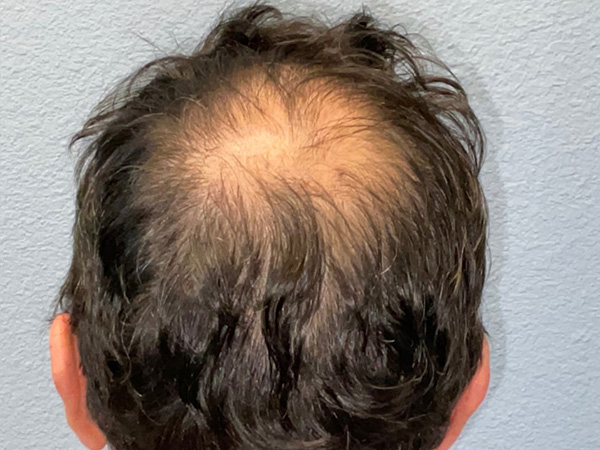 Hair Transplant