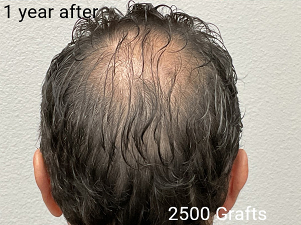 Hair Transplant