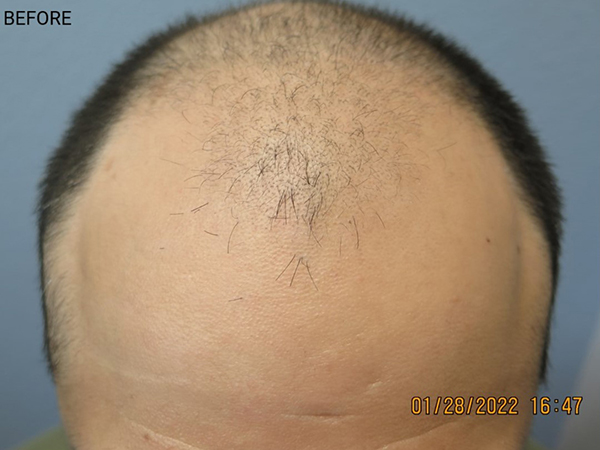 Hair Transplant