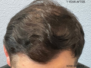 Hair Transplant