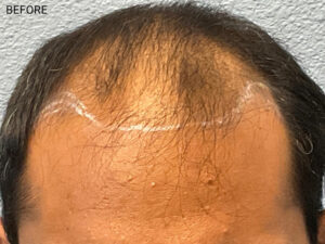 Hair Transplant