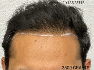 Hair Transplant