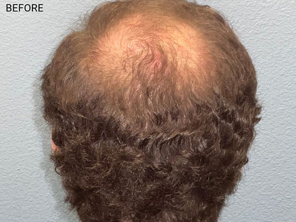 Hair Transplant