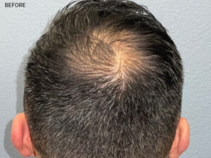Hair Transplant