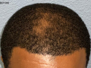 Hair Transplant