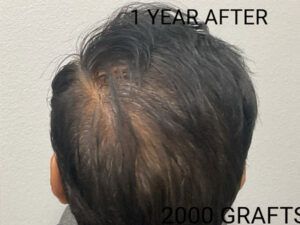 Hair Transplant