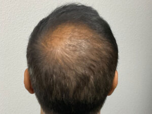Hair Transplant