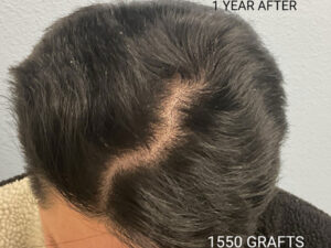 Hair Transplant