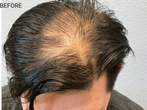 Hair Transplant