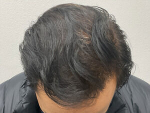 Hair Transplant
