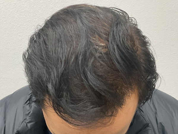 Hair Transplant