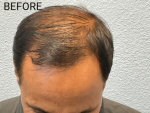 Hair Transplant