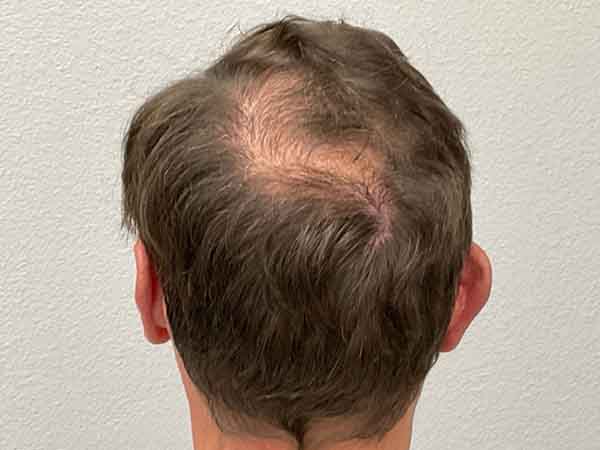 Hair Transplant