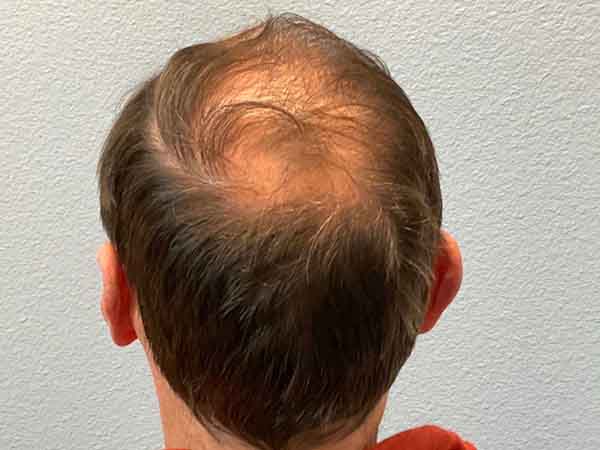 Hair Transplant