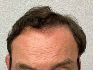 Hair Transplant