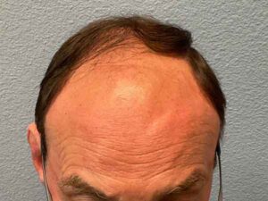 Hair Transplant