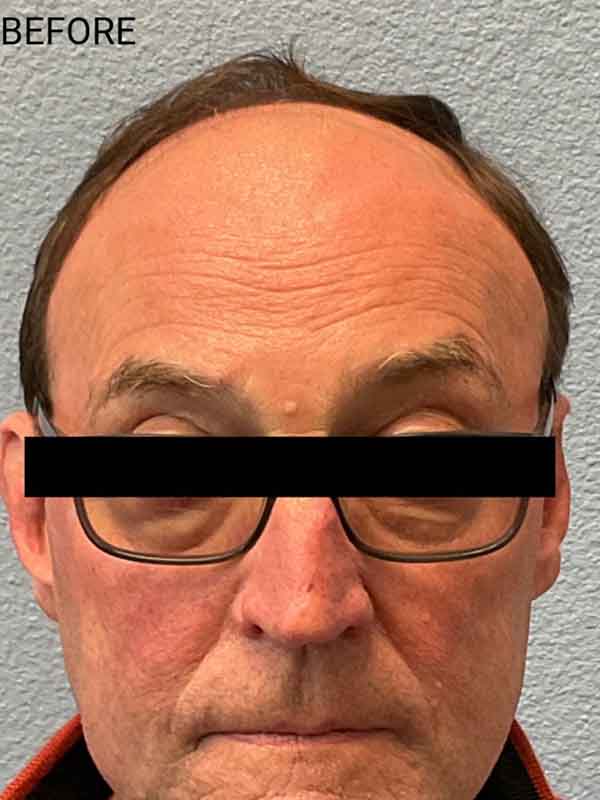 Hair Transplant