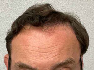 Hair Transplant