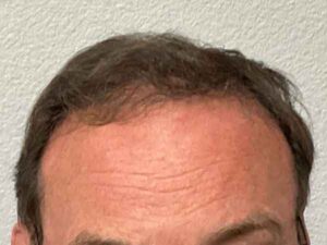 Hair Transplant