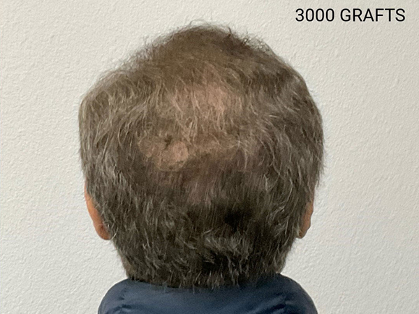 Hair Transplant