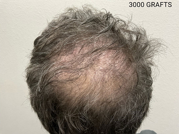 Hair Transplant