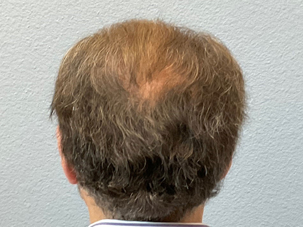 Hair Transplant