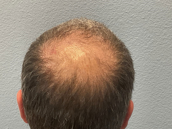 Hair Transplant