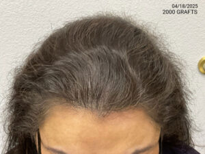 Hair Transplant