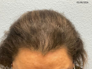 Hair Transplant