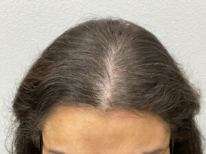 Hair Transplant