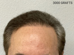 Hair Transplant