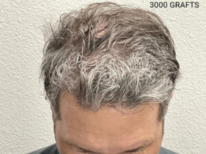 Hair Transplant