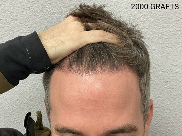 Hair Transplant