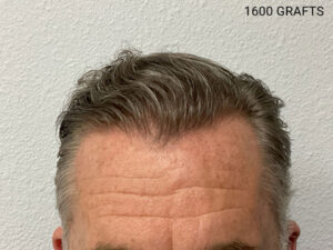 Hair Transplant