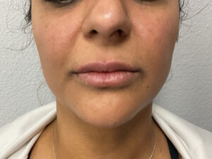 Dermal Fillers