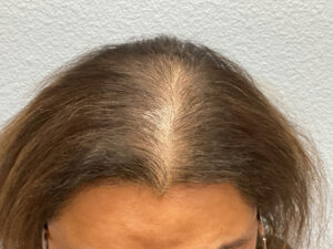 Hair Transplant