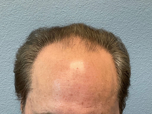 Hair Transplant