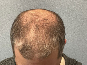 Hair Transplant