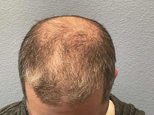 Hair Transplant