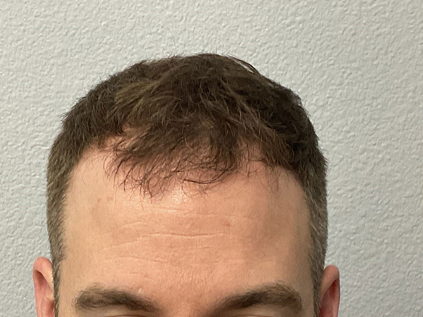 Hair Transplant