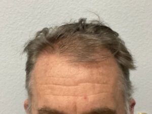 Hair Transplant