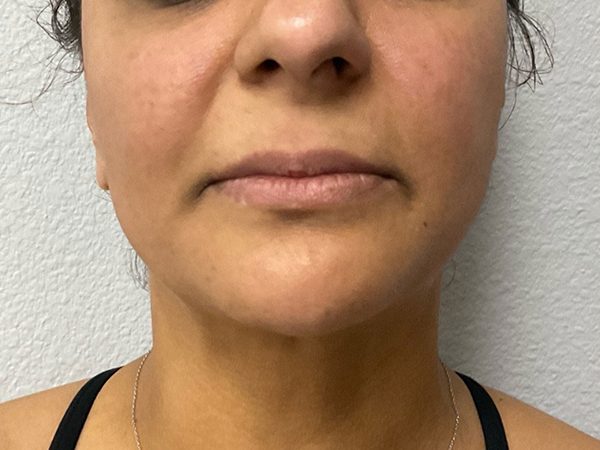 Dermal Fillers