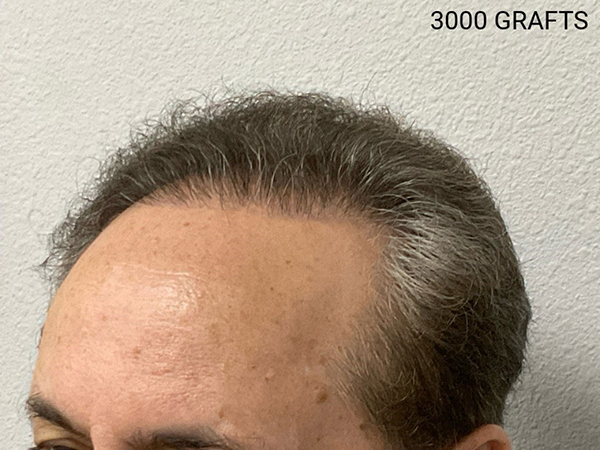 Hair Transplant