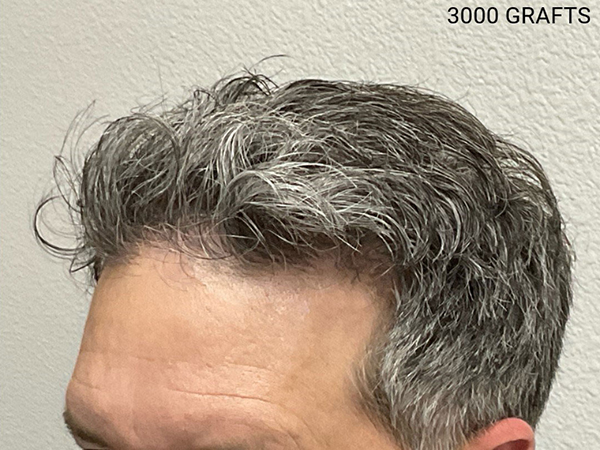 Hair Transplant