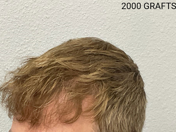 Hair Transplant