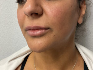 Dermal Fillers
