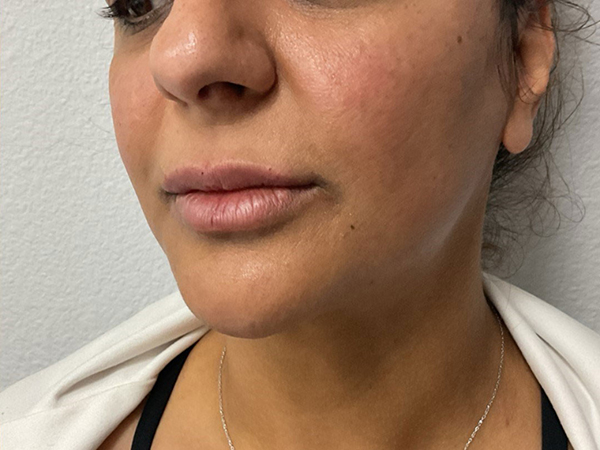Dermal Fillers