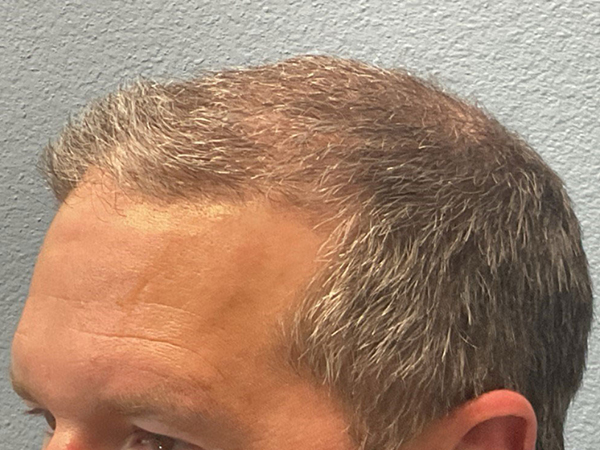 Hair Transplant