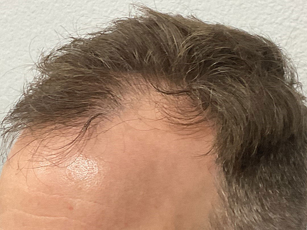 Hair Transplant